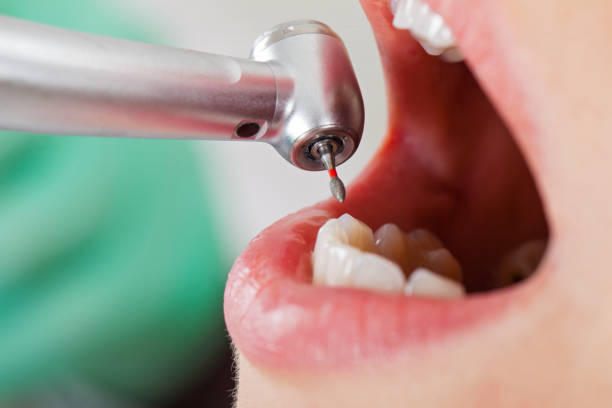 Best Emergency Dentist for Lost Fillings or Crowns in Tangerine, FL